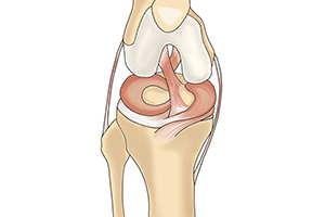 коленный мениск