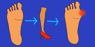 Hallux valgus. Вальгусная деформация первого пальца стопы