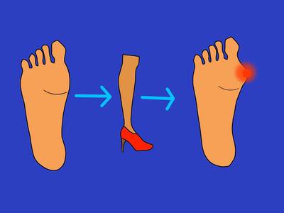 Hallux valgus. Вальгусная деформация первого пальца стопы