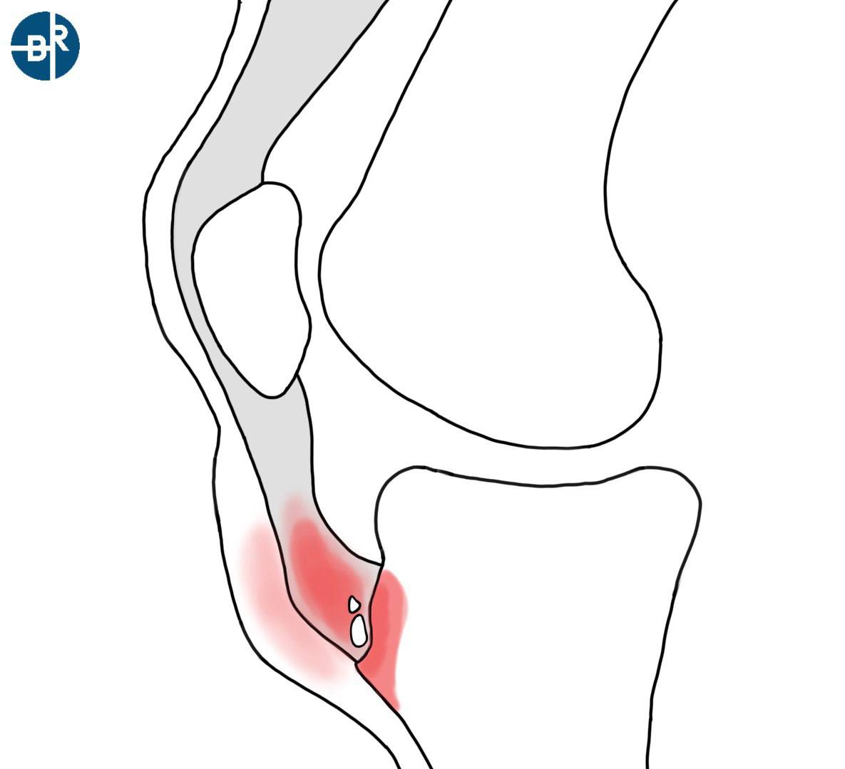 болезнь шляттера