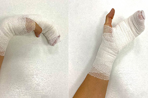 иммобилизация кисти