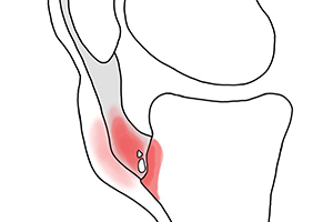 болезнь шляттера