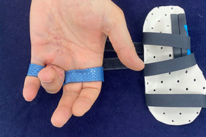 Контрактура Дюпюитрена