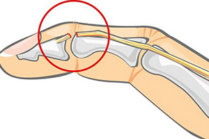 палец молоточек на руке