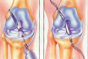 реабилитация после пластики пкс