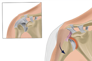 вывих в плечевом суставе